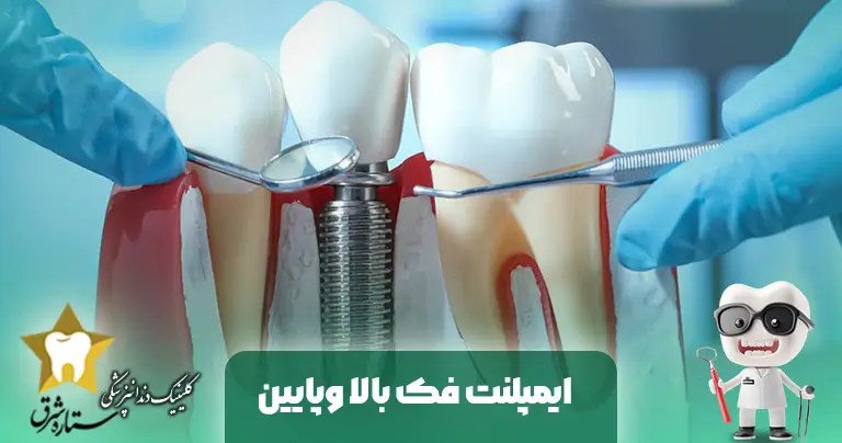 تفاوت بین ایمپلنت های دندانی در فک بالا و پایین