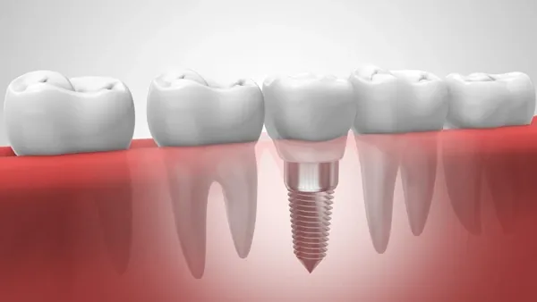 Complications of dental implants Facts you should know! - Center for Gum and Implant Surgery, Dr. Affir and Dr. Shanae