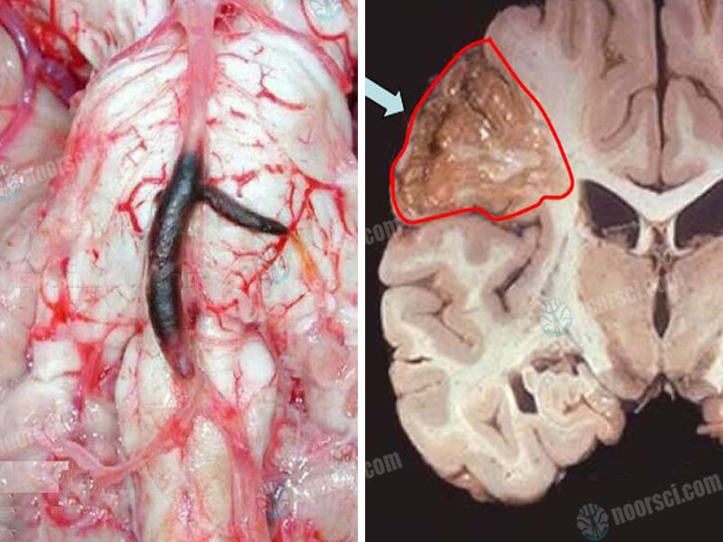 خدمات السكتة الدماغية