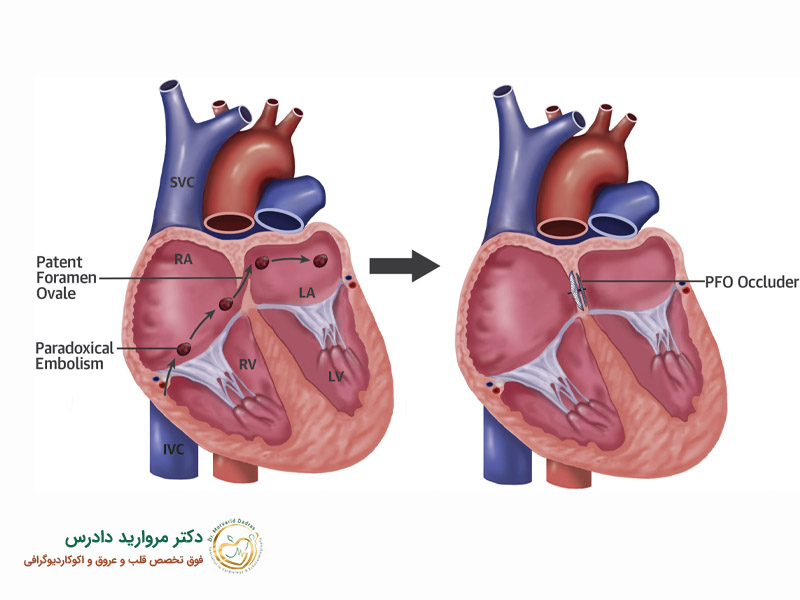 ما هو ثقب في القلب؟ الأعراض وطرق العلاج - د. مارفاريد دادرس