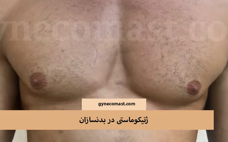 ژنیکوماستی در بدنسازان