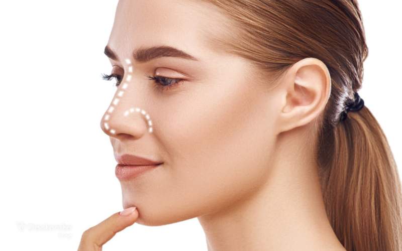 Answers to important questions about the contour line in nose surgery