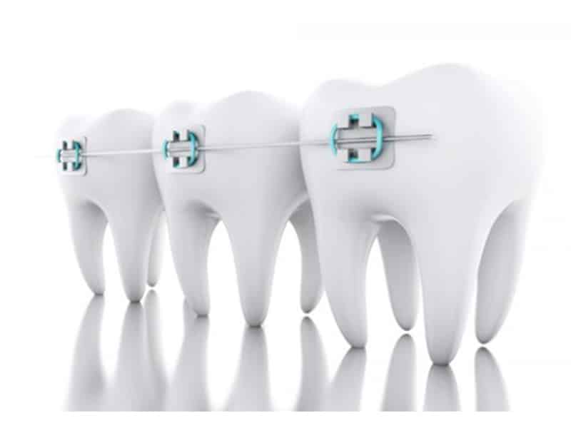 What is tooth crowding?