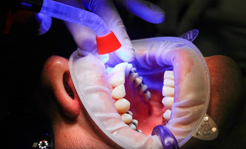 How long are the number of dental composite sessions? Simin Barangi