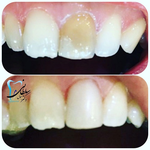 اصلاح و تغییر رنگ دندان توسط کامپوزیت دکتر جمال سلطانی جراح، دندانپزشک و متخصص ایمپلنت در تبریز