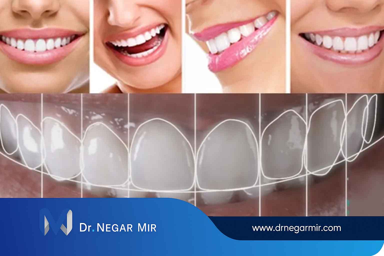 دليل العناية بعد صفائح الأسنان والقشرة المركبة 1404