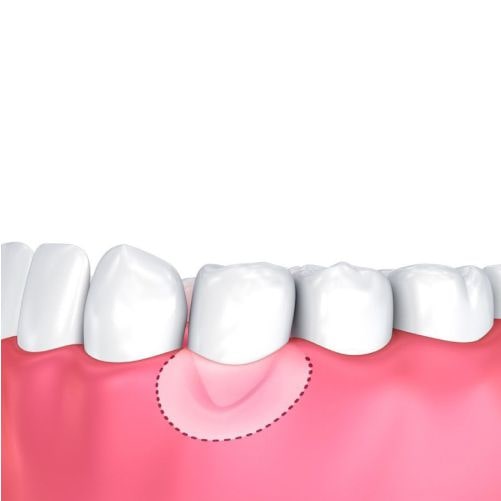 Gum surgery [methods, steps and cost] + expert advice