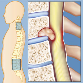 روش های جراحی تومور نخاع و نکات مهم بعد از عمل