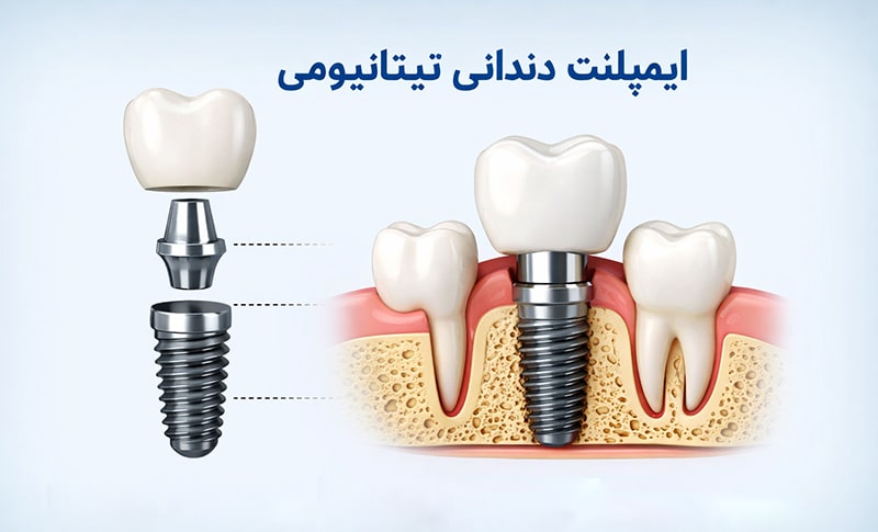 What is a titanium implant? + price, advantages and disadvantages Amytis