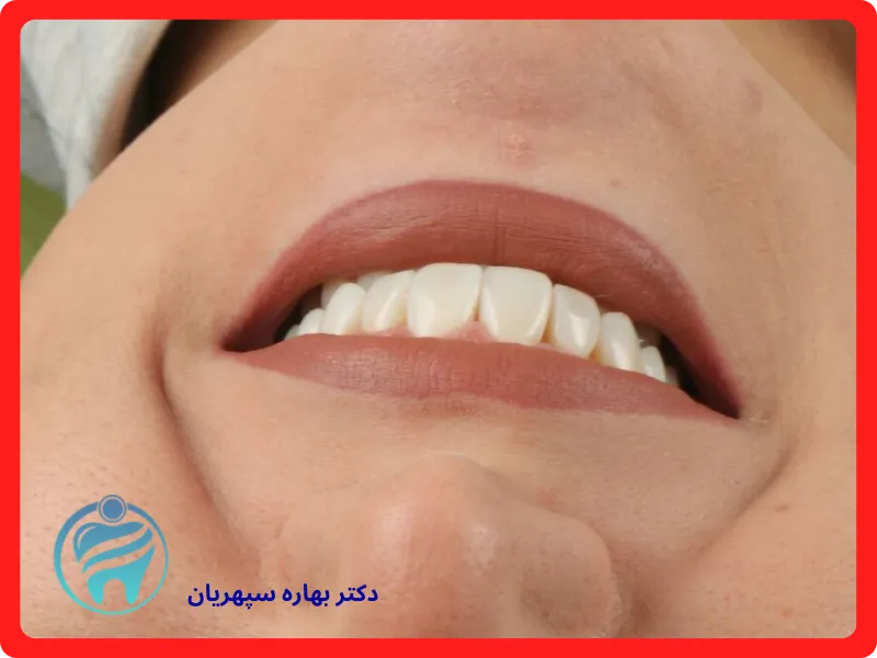 صورة لصفائح الأسنان قبل وبعد العينات الحقيقية 1404