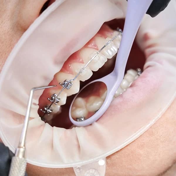 The reason for tooth extraction in orthodontics? Everything you need to know! - Dr. Dana Zandian