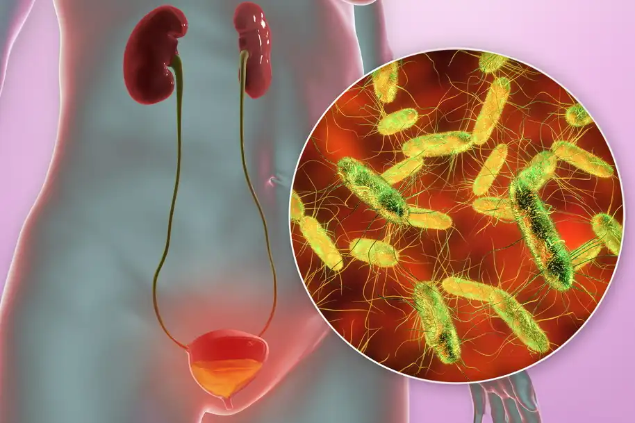 درمان عفونت ادراری - مرکز اورولوژی جهانشهر