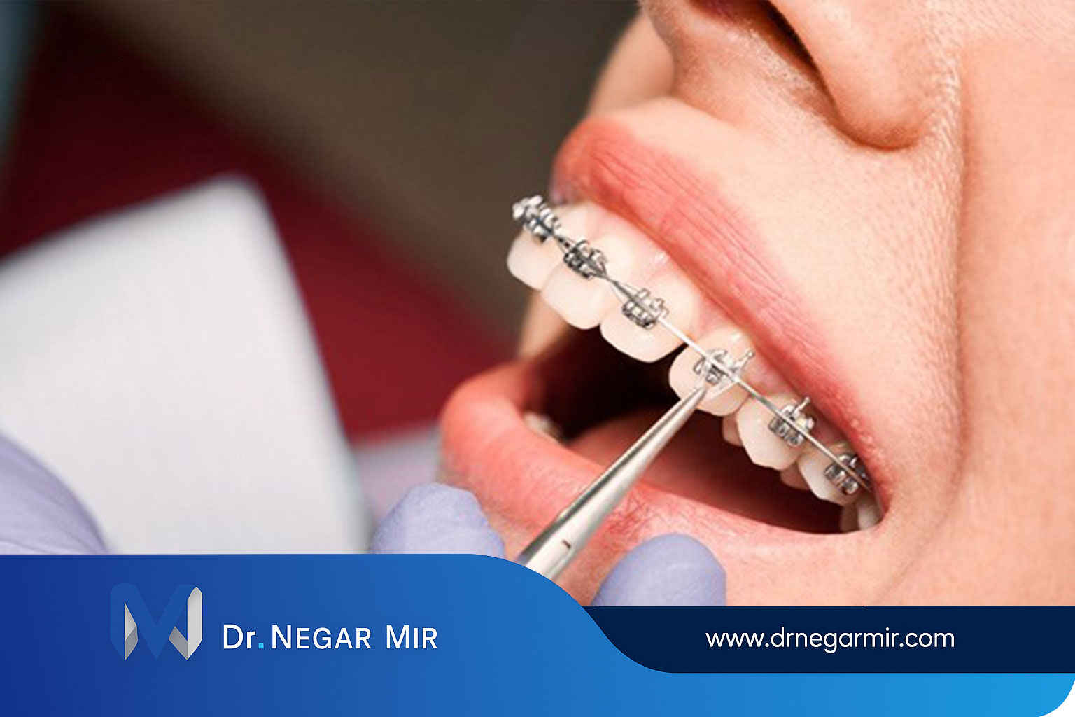 تقويم الأسنان غير المرئي و 8 طرق لتقويم الأسنان في عيادة الدكتور مير