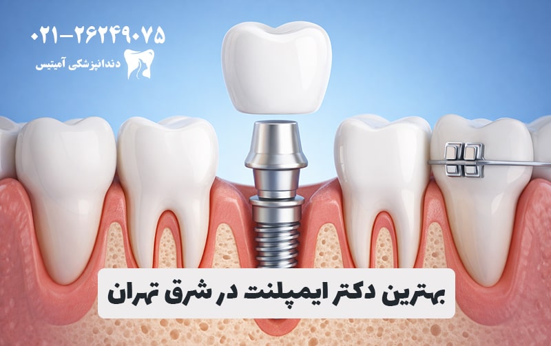10 digital implant centers and doctors in the east of Tehran Amytis