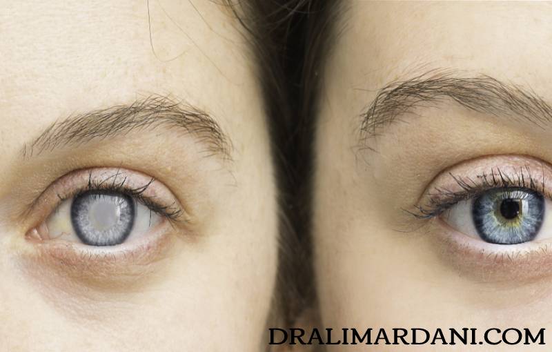 Glaucoma surgery - Dr. Hossein Alimardani