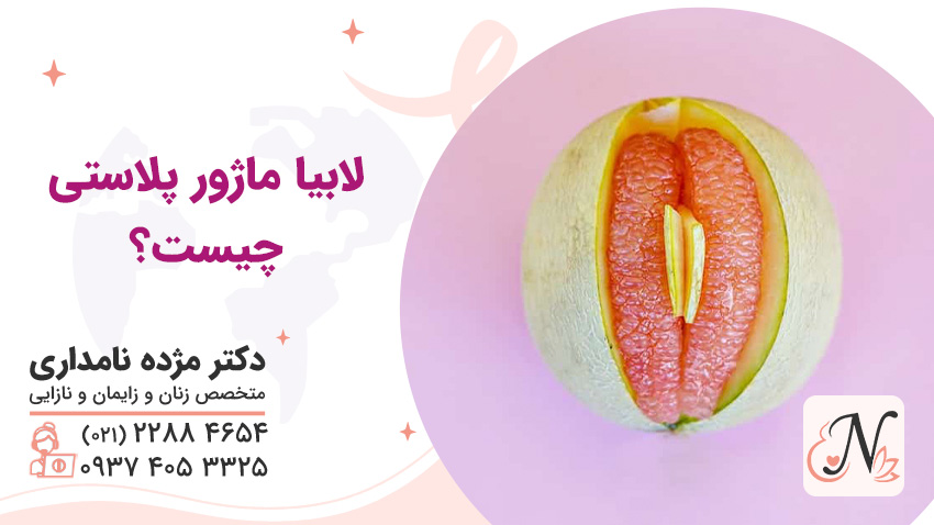 What is labia majoroplasty?