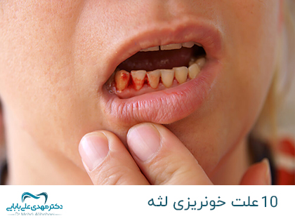 10 ما هي أسباب نزيف اللثة؟ - د. مهدي علي بابائي