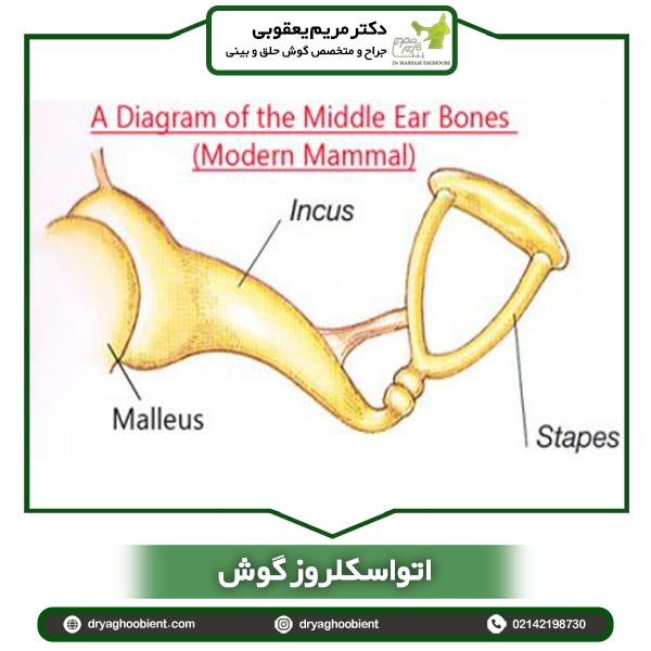 Otosclerosis of the ear + effective treatment and repair of the ear bone Dr. Maryam Yagoubi