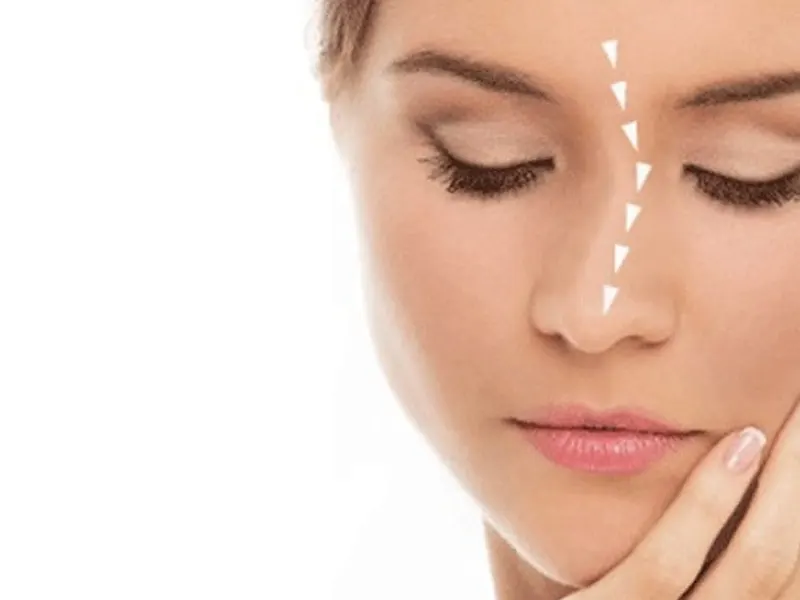 Crooked nose surgery; Steps, cost and necessary care