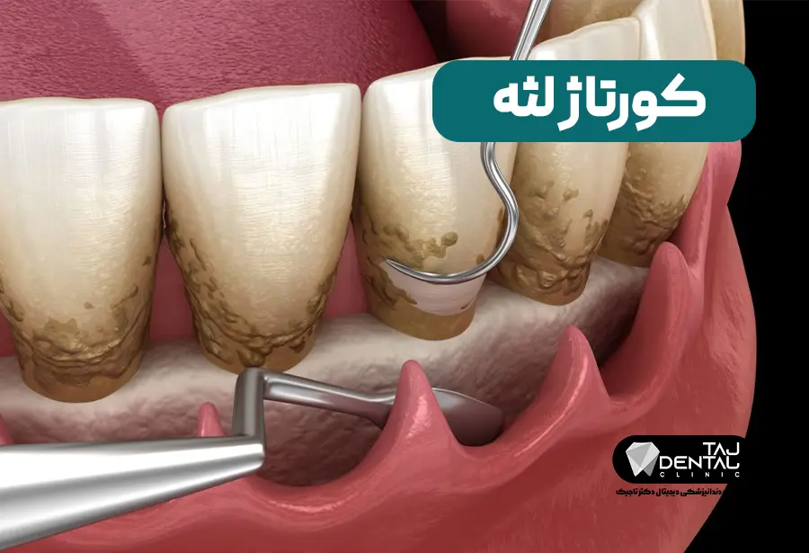 Gum curettage Complete guide + pros, cons and cost