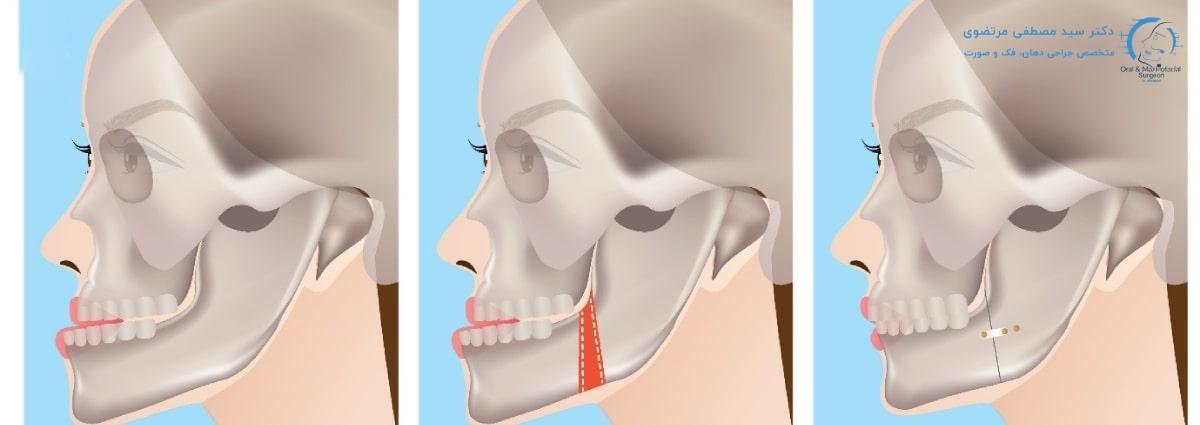 Jaw surgery (orthognathics). Correction of upper and lower jaw abnormalities Fees and charges 1404