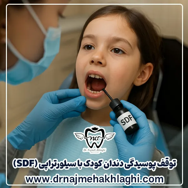 Silver therapy (SDF) in children Treatment of tooth decay without pain and filling - Dr. Najmeh Ethali