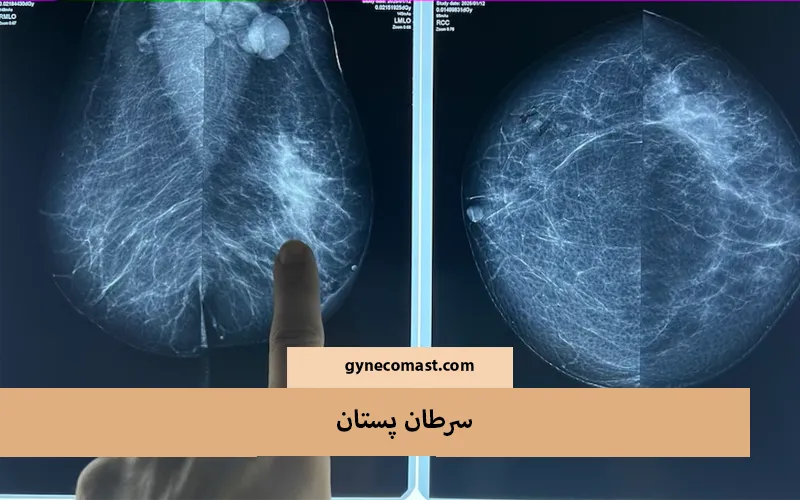 سرطان پستان