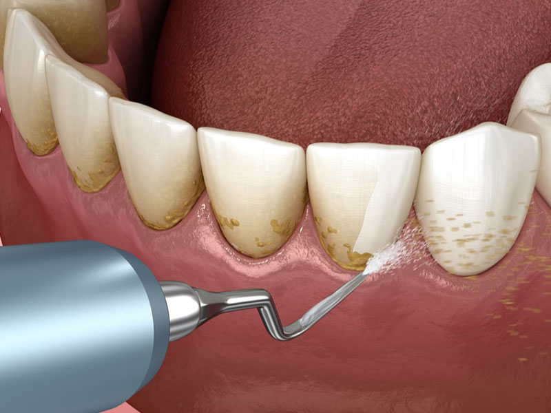 Dental scaling; Steps and benefits of doing it