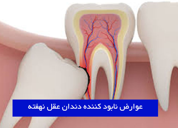 What are the complications of wisdom teeth?