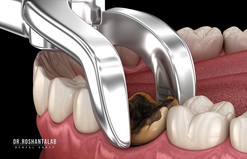 کاشت ایمپلنت 3 ماه پس از کشیدن دندان: 4 دلیل مهم