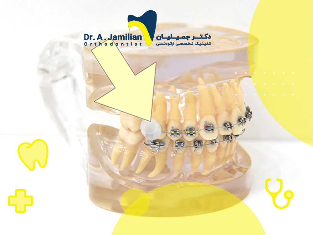 Is orthodontic wax edible? - Dr. Jamilian
