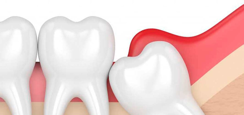 A comprehensive guide to perichronitis and its treatment methods