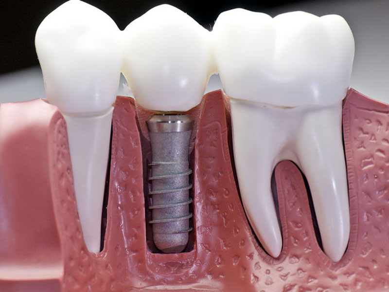 Obesity and dental implant success: Does excess weight affect dental implants?