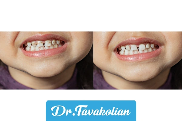 اختلال رشدی مینای دندان - دکتر توکلیان