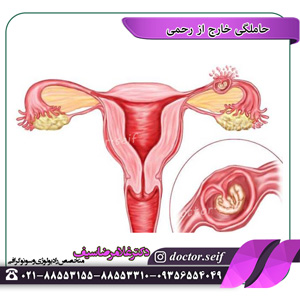 Diagnosis of ectopic pregnancy