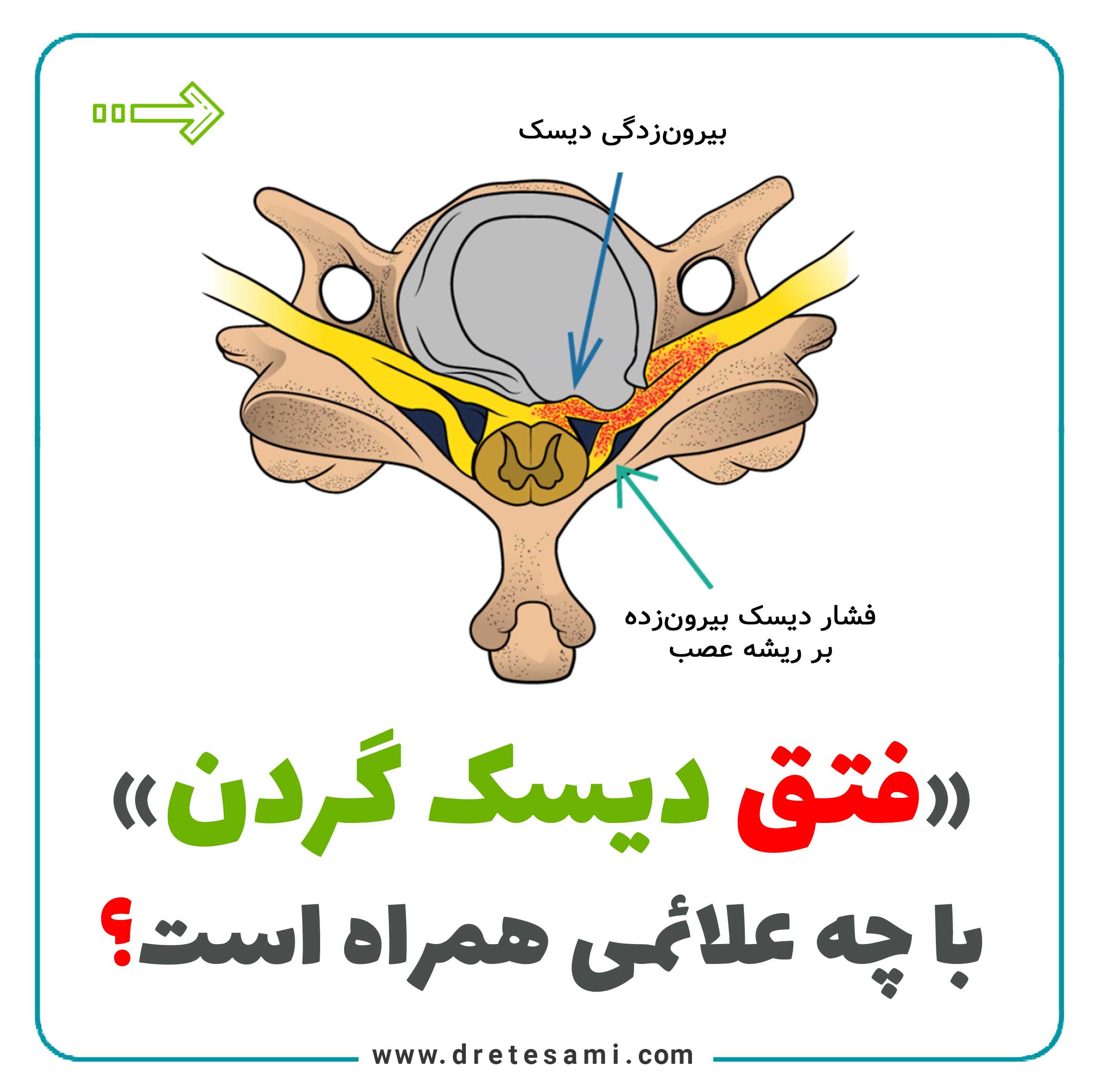 What are the symptoms of cervical disc herniation?