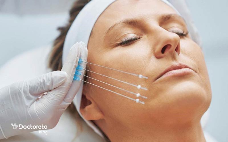 انواع نخ های لیفت صورت و هر آنچه که باید در مورد آنها بدانید