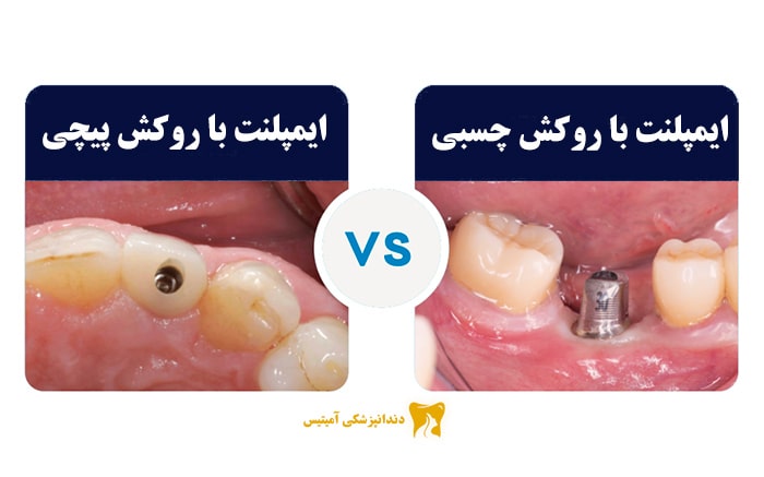 Is the adhesive implant cover better or screw? Check the differences Amytis