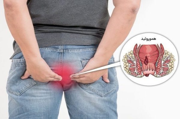 ما هو البواسير؟ - دكتور كرامتي أخصائي جراحة القولون - أفضل جراح قولون