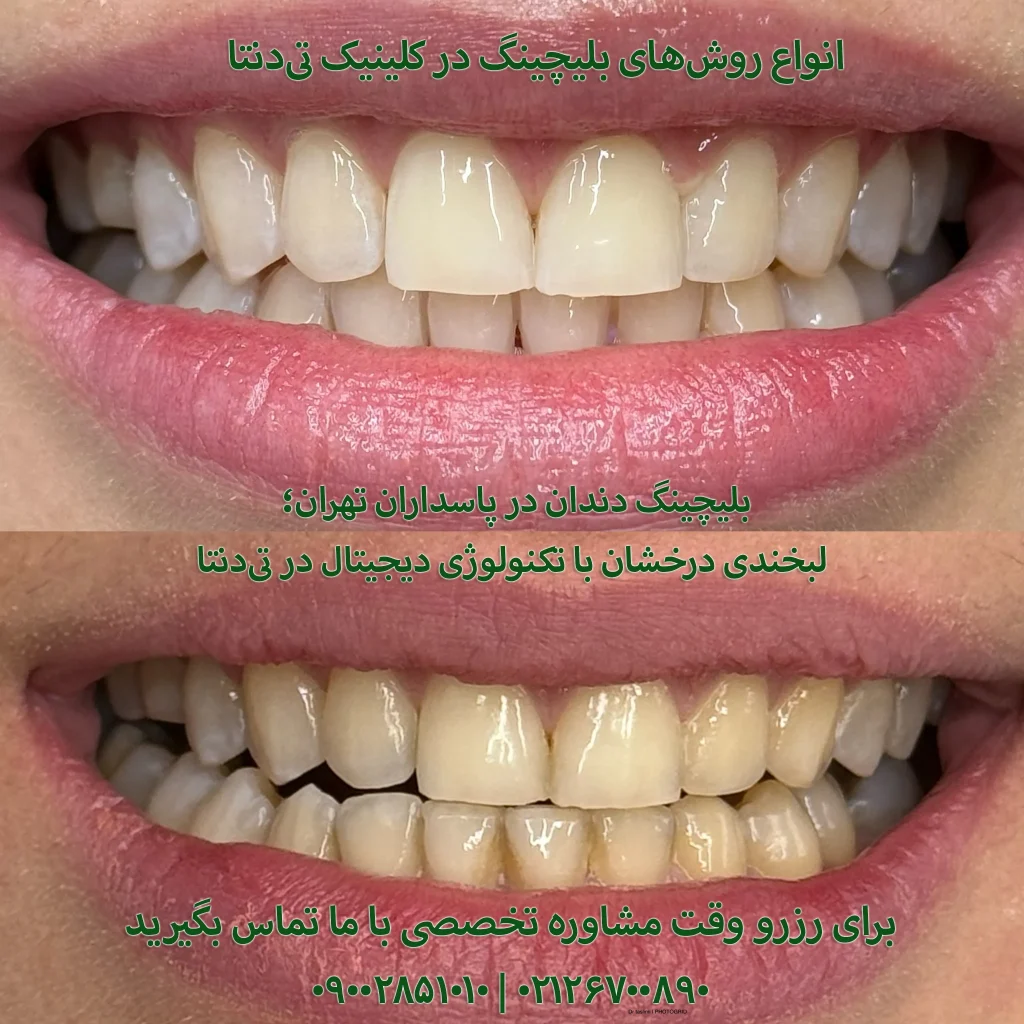 بلیچینگ دندان در پاسداران + [هزینه ۱۴۰۳] | کلینیک Tdenta
