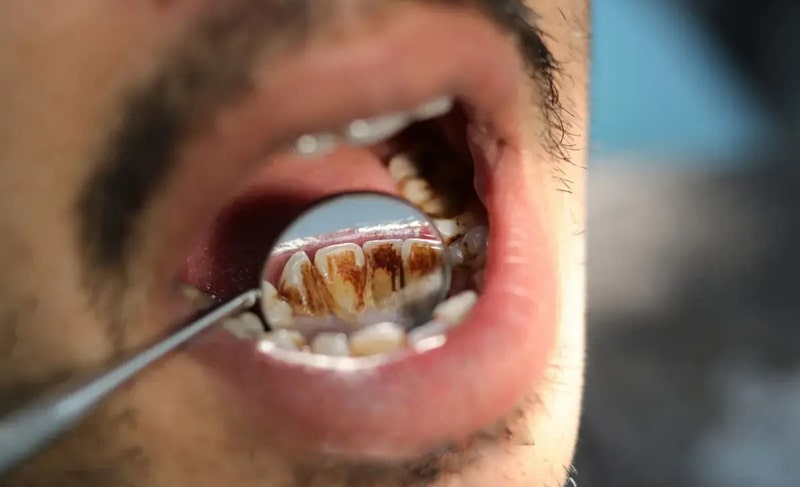 Tooth decay under dental laminate + treatment Simin Barangi