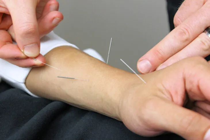 Acupuncture - Dr. Morteza Tabatabai