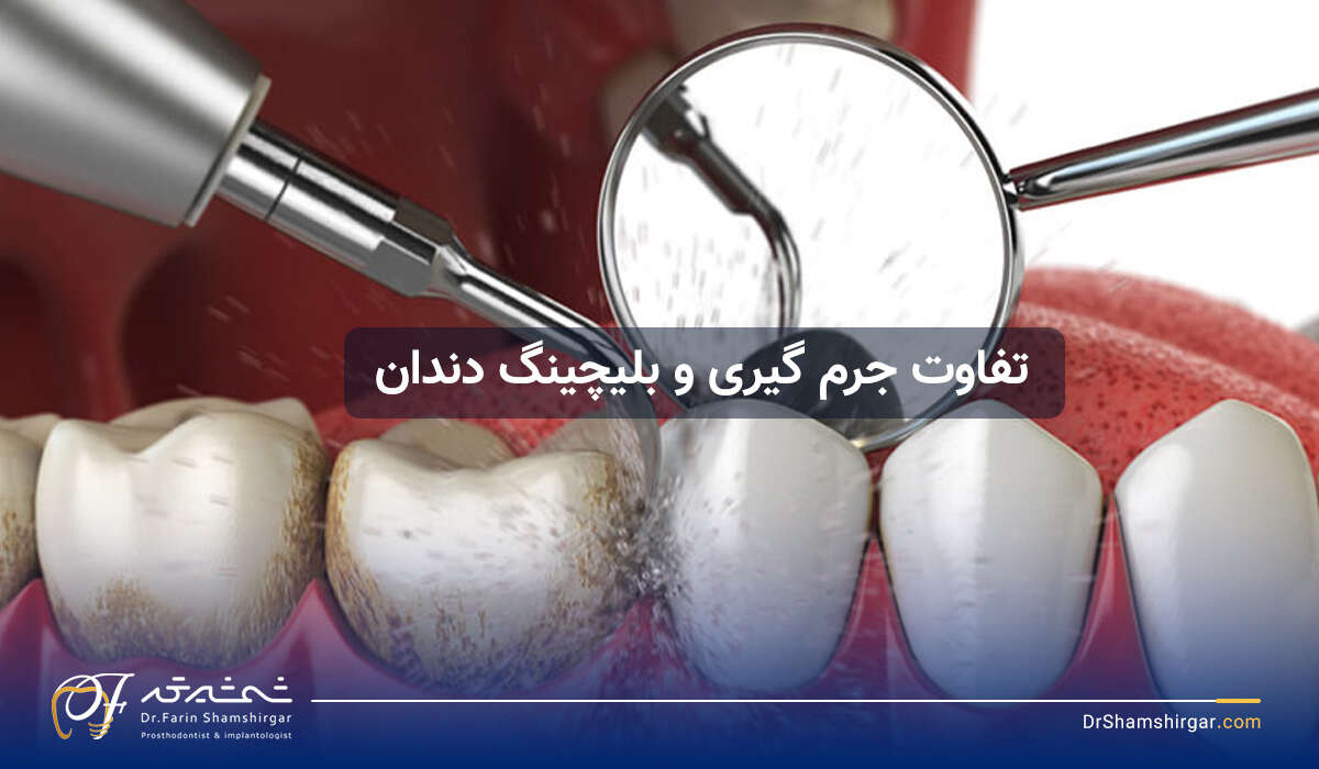 The difference between scaling and teeth bleaching: 5 important differences