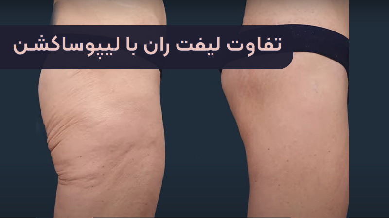 الفرق بين شد الفخذين وشفط الدهون (مقارنة بين طريقتين للتجميل)