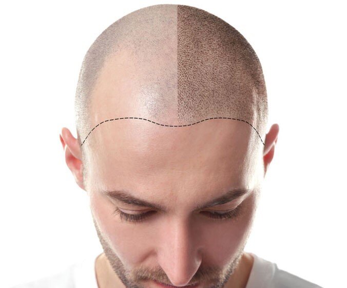 Head scalping center in the north of Tehran