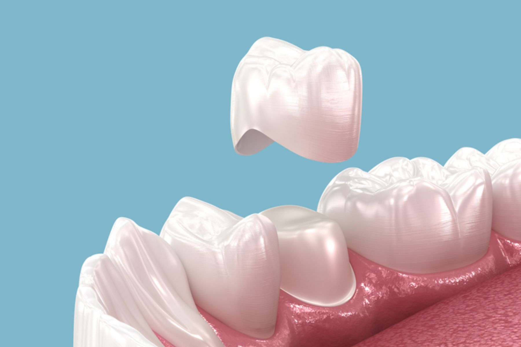 قشور الأسنان