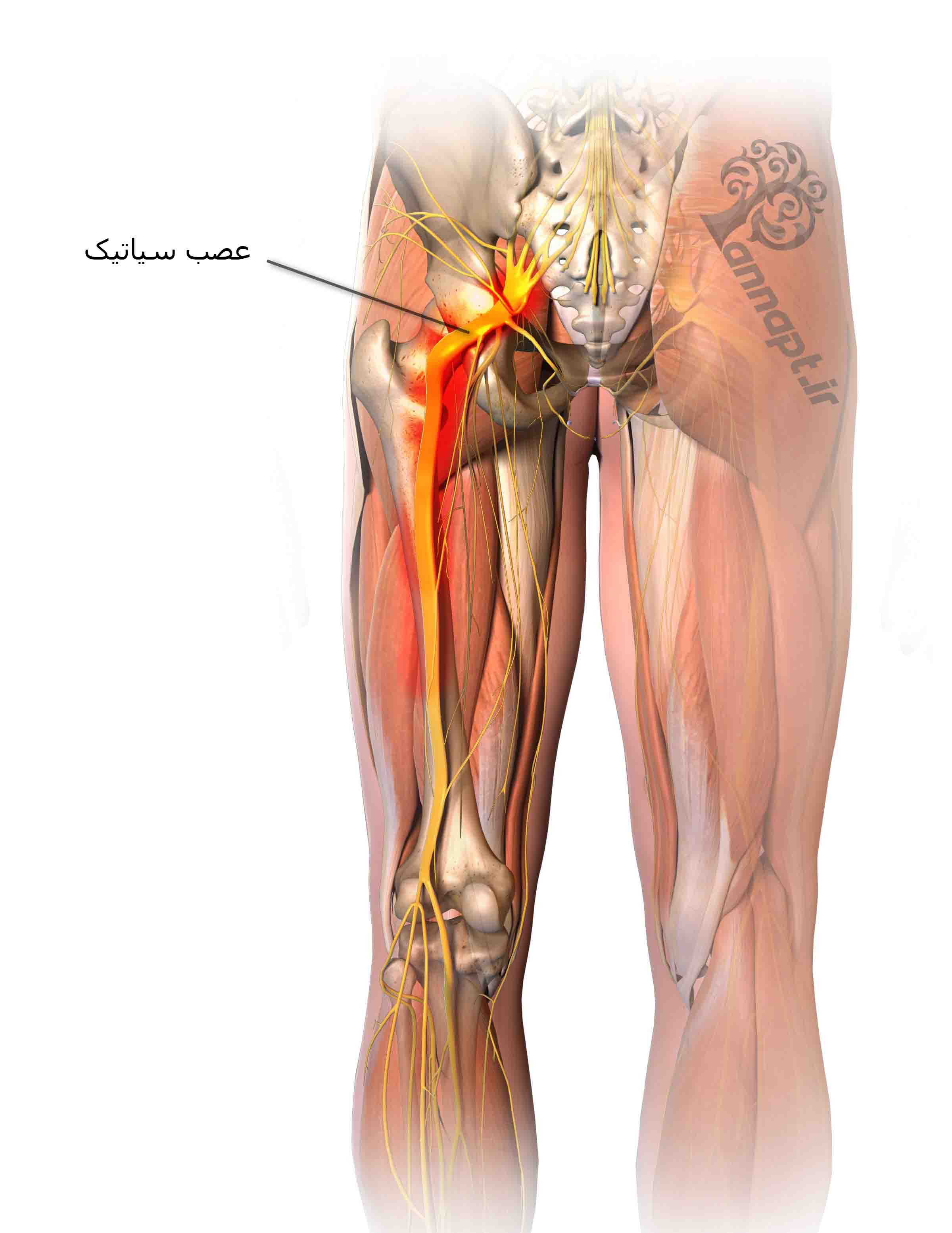 كل ما تريد معرفته عن ألم عرق النسا وتشخيصه وطرق علاجه!