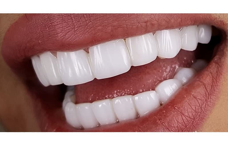 Is dental composite permanent? A complete review of the lifespan and durability of composites