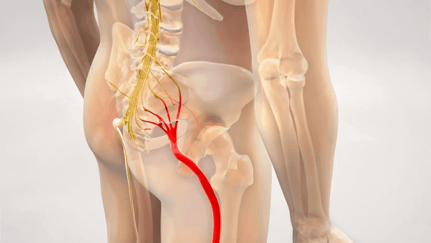 أفضل أمبولة لآلام عرق النسا