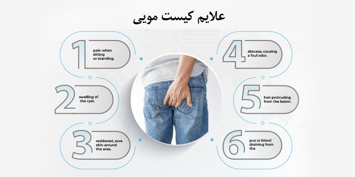 بهترین مرکز لیزر کیست مو در تهران